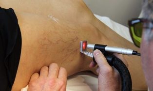 Behandlung vun Krampfadern mat Laser